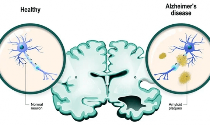 OLEOCANTHAL AS A NEUROPROTECTIVE MECHANISM AGAINST ALZHEIMER'S DISEASE